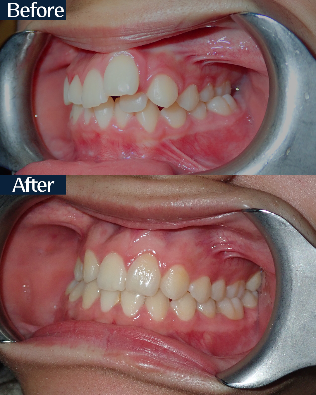 Before — left side