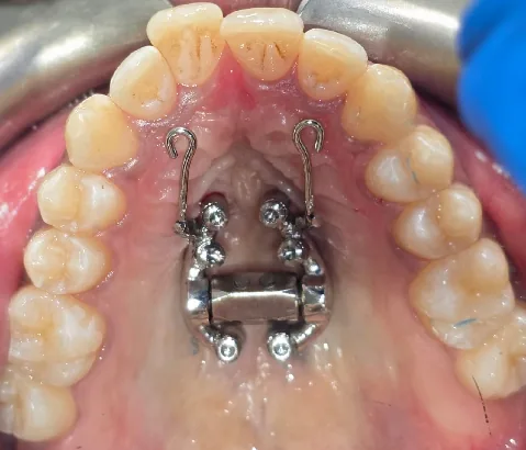 MARPE miniscrew-assisted rapid palatal expander viewed intraorally