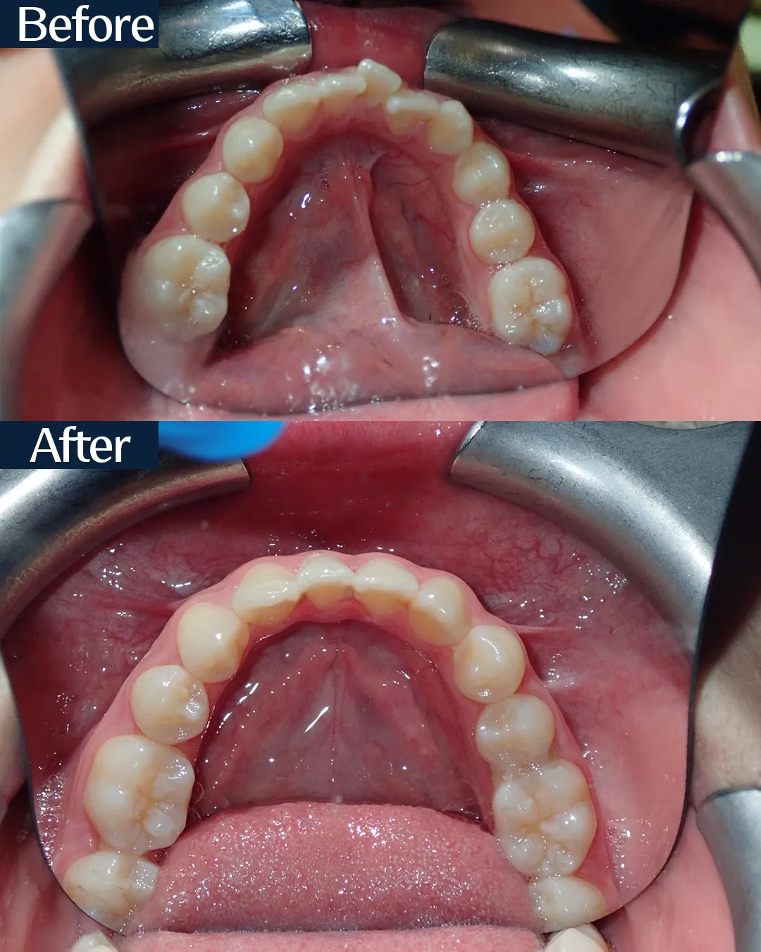 MARPE palatal expansion case 1 — intraoral view before and after treatment