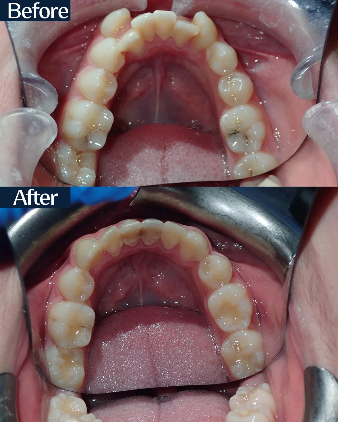 MARPE palatal expansion case 2 — intraoral view before and after treatment