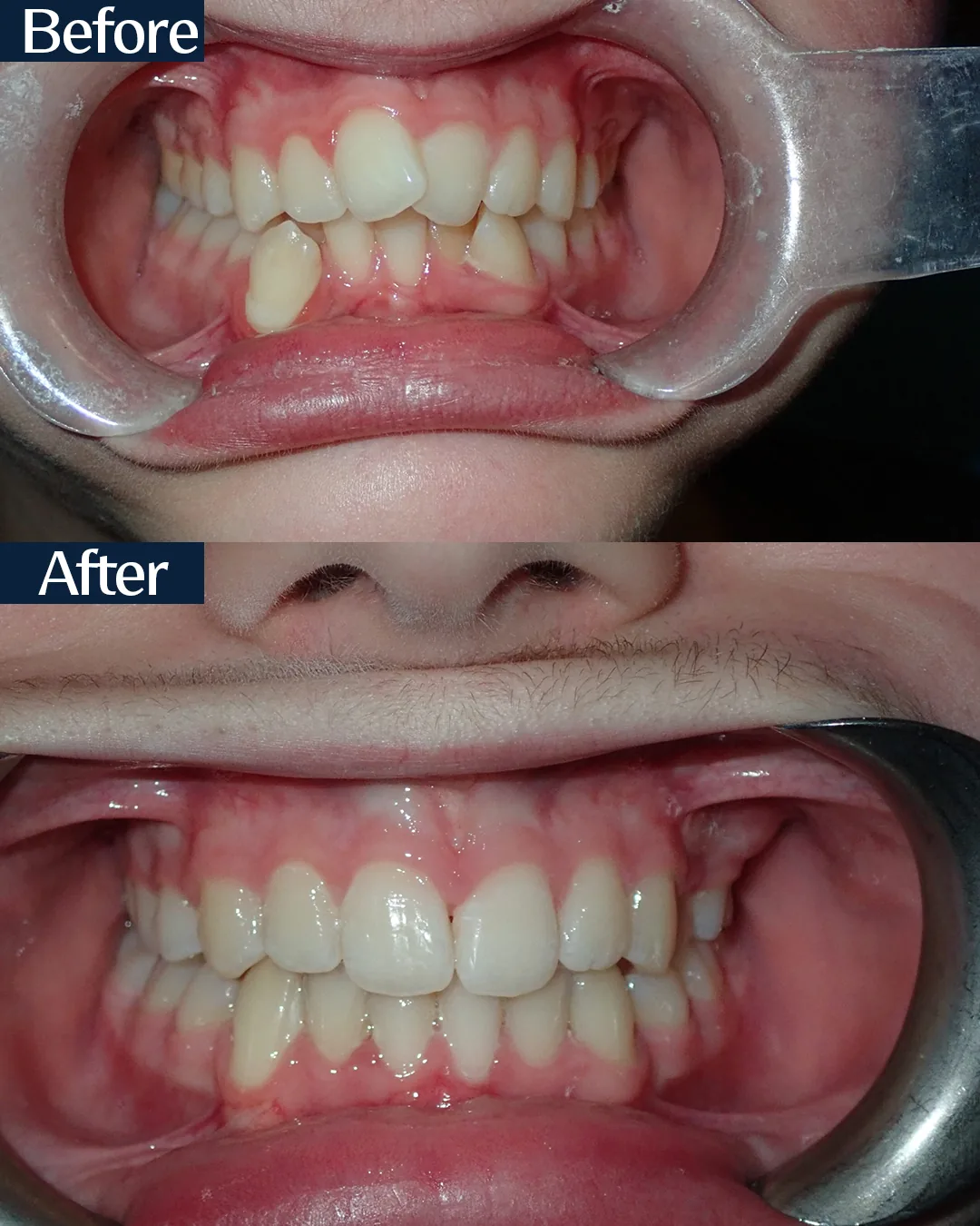 MARPE palatal expansion case 3 — frontal view before and after treatment