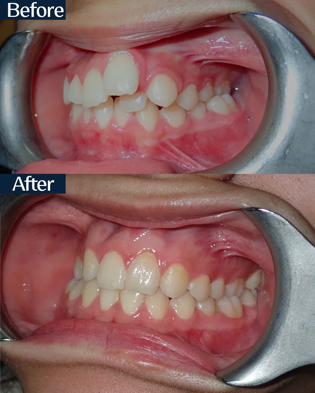 MARPE palatal expansion case 4 — occlusal view before and after treatment