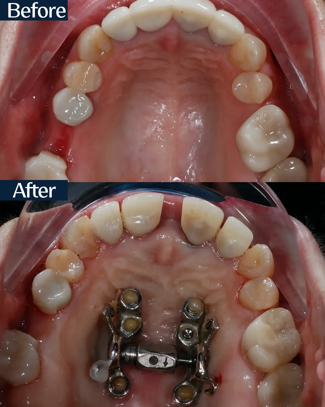 MARPE palatal expansion case 5 — intraoral view before and after treatment