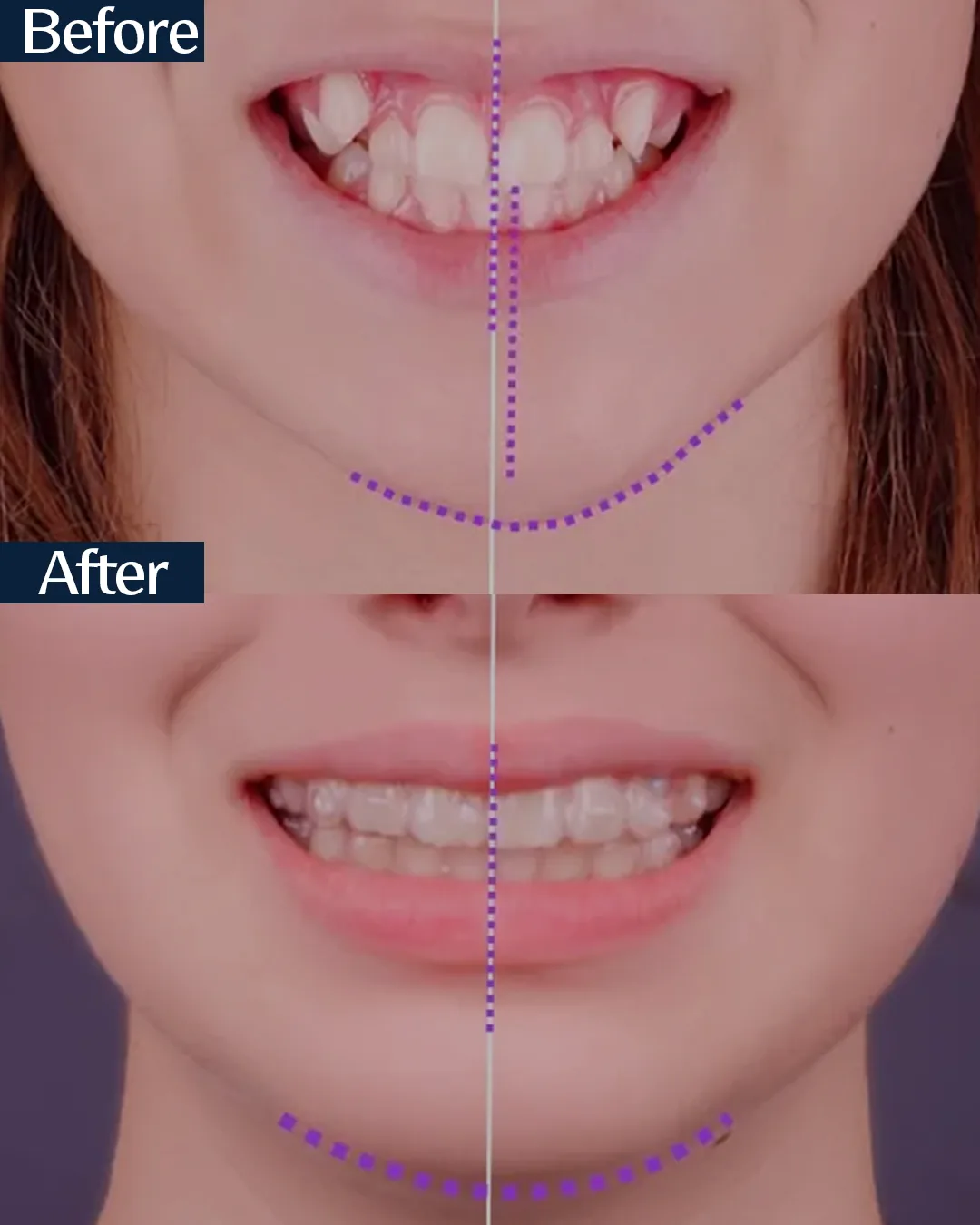 MARPE palatal expansion case 6 — intraoral view before and after treatment