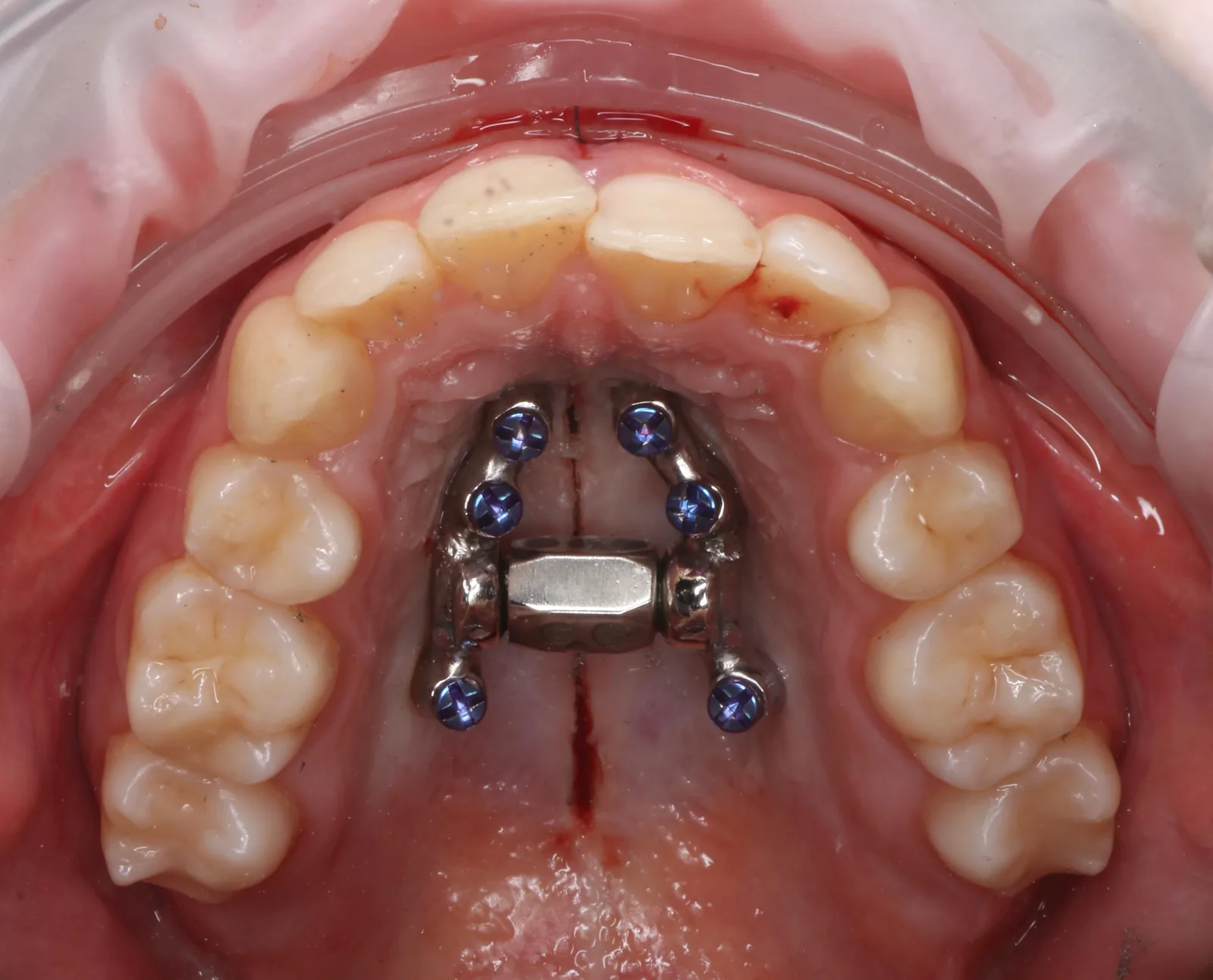Clinical detail of a bone-anchored device used alongside TAD anchorage
