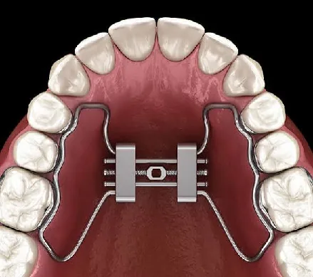 Illustration of a bone-anchored maxillary expansion appliance
