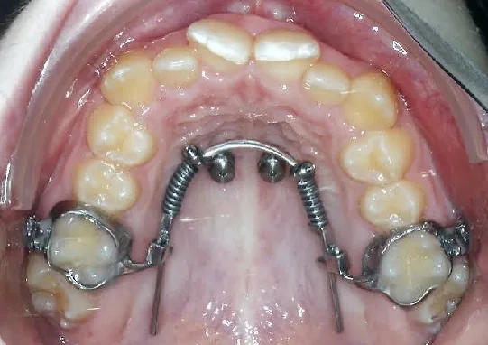 Fixed Braces