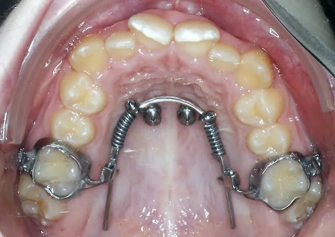 Beneslider molar distalization appliance viewed intraorally