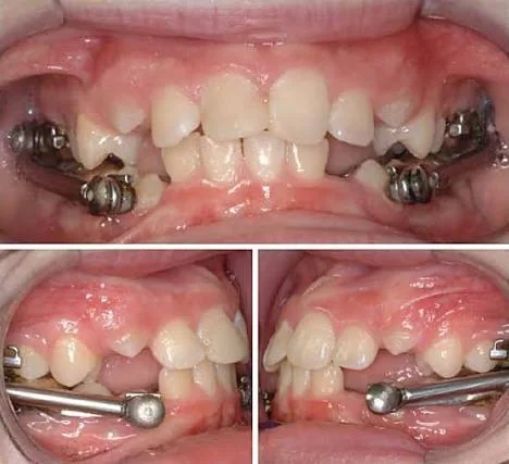Fixed Herbst functional appliance shown intraorally