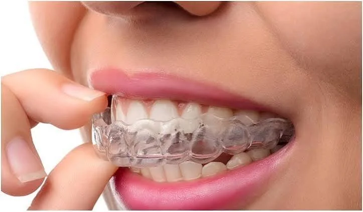 Invisalign clear aligner being held up to the teeth before fitting