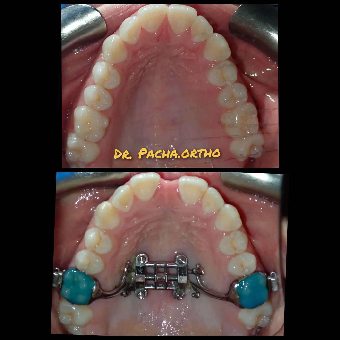 Dr. Pacha's own MSE case, before and after expansion