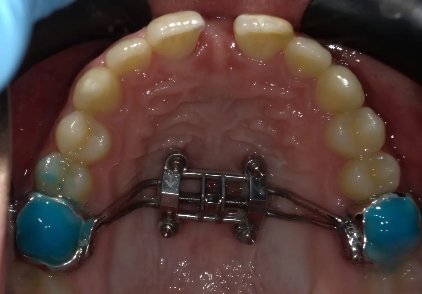 Maxillary skeletal expander viewed intraorally