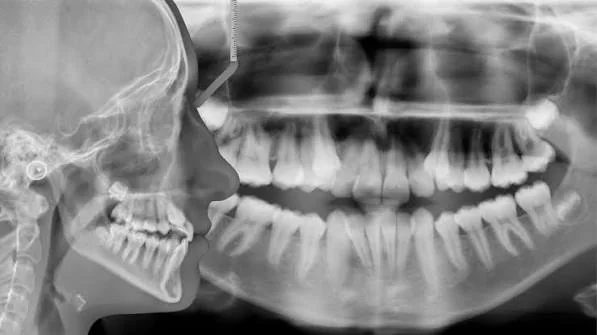 Panoramic and cephalometric X-ray used for 2D and 3D imaging