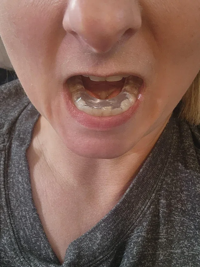 Patient wearing a clear jaw-repositioning splint