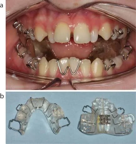 Removable Twin Block functional appliance