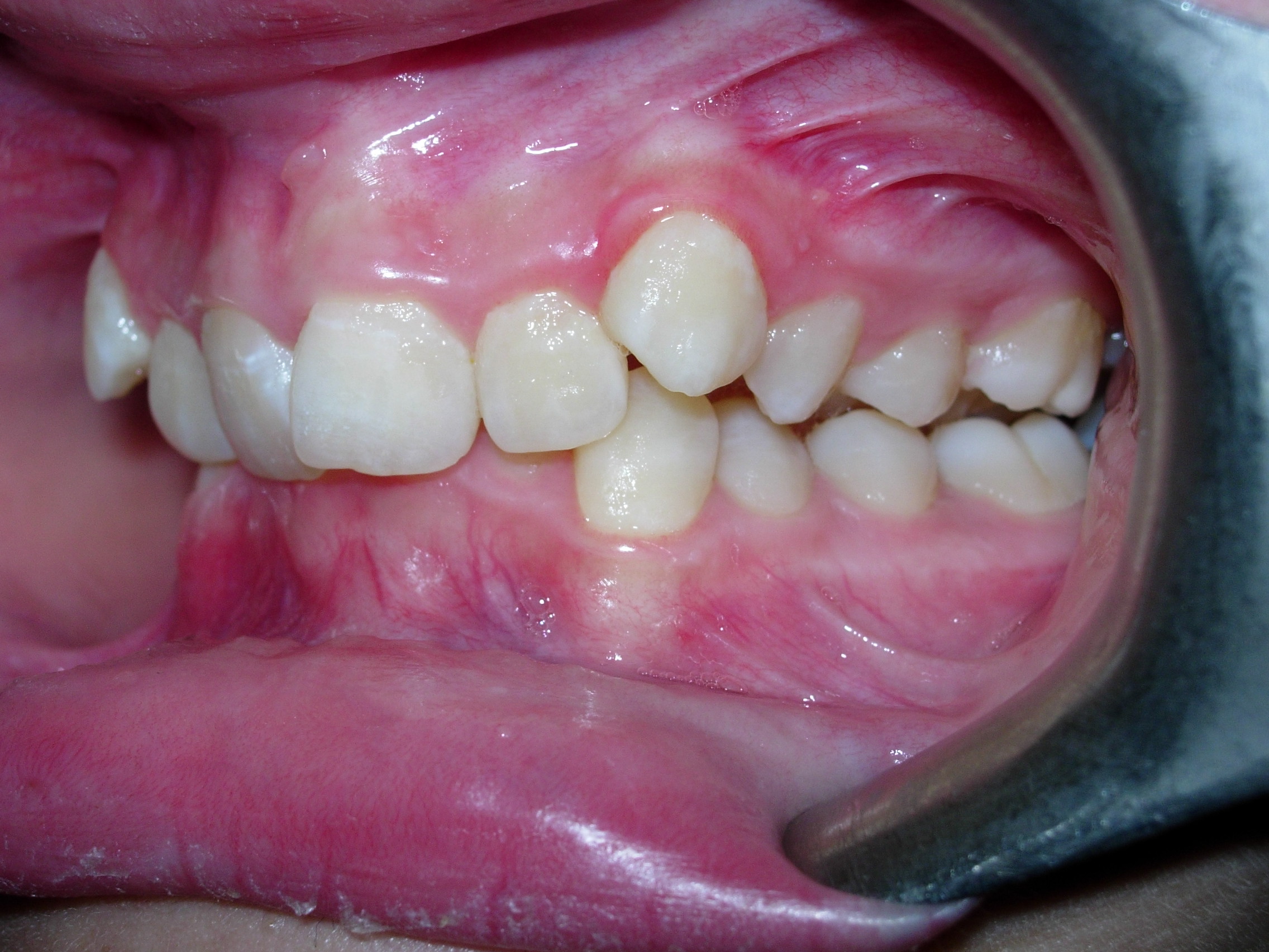 Before — left side