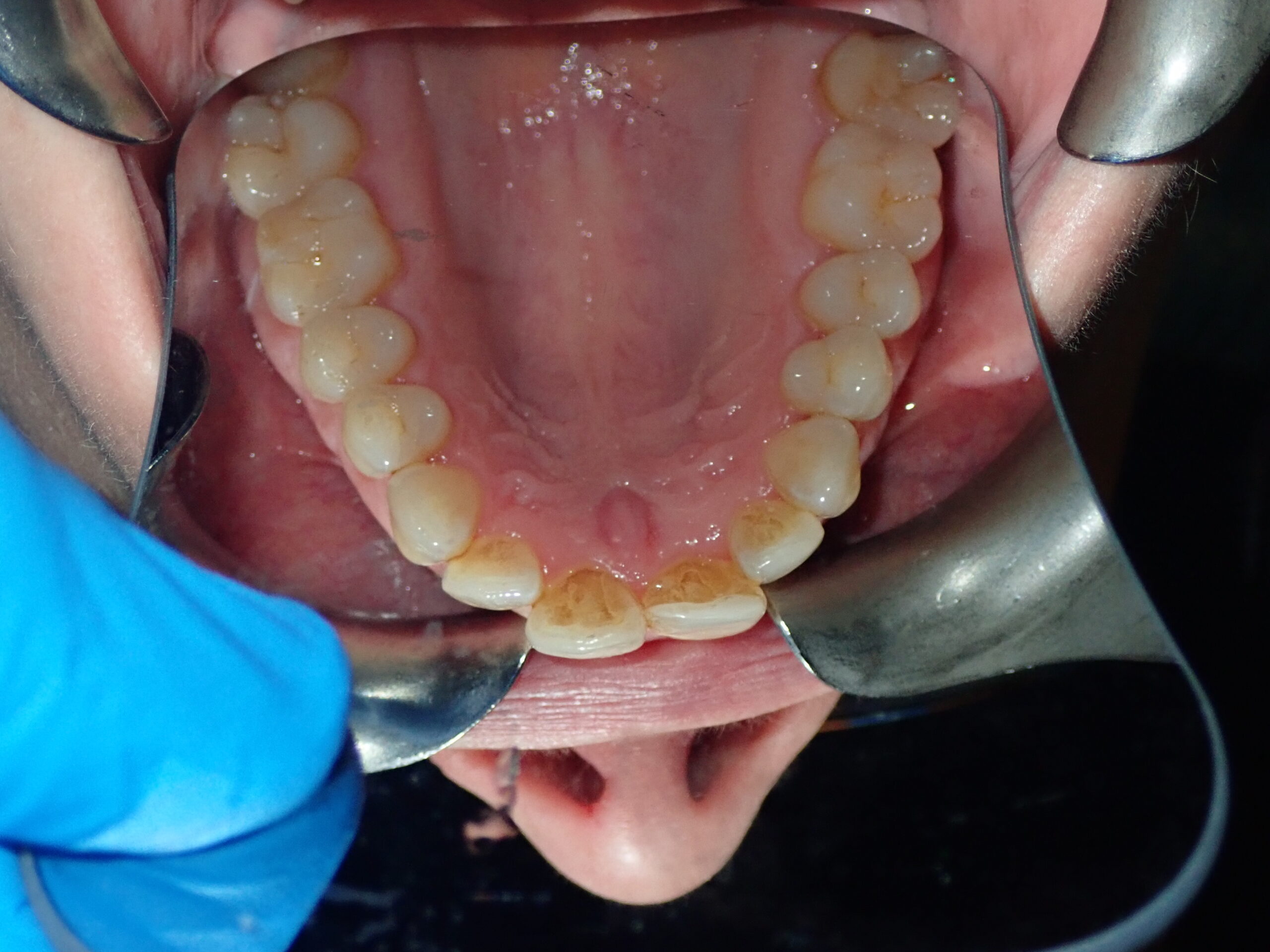 Before treatment